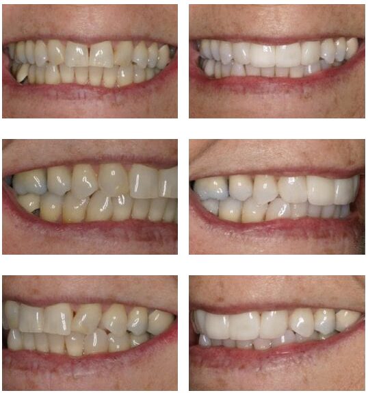 Before and after teeth fixed with implants