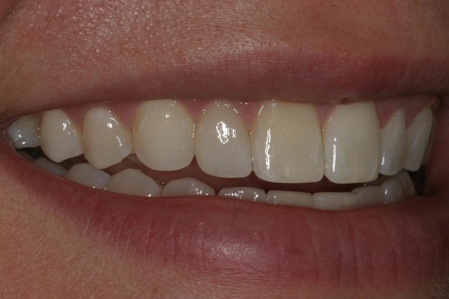 after-veneers