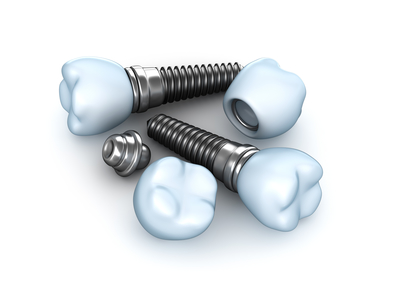 dental-implants-1