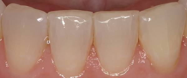 bottom teeth reshaping