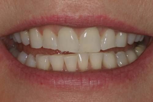 Porcelain Veneers - David A. Cook, DDS, PA