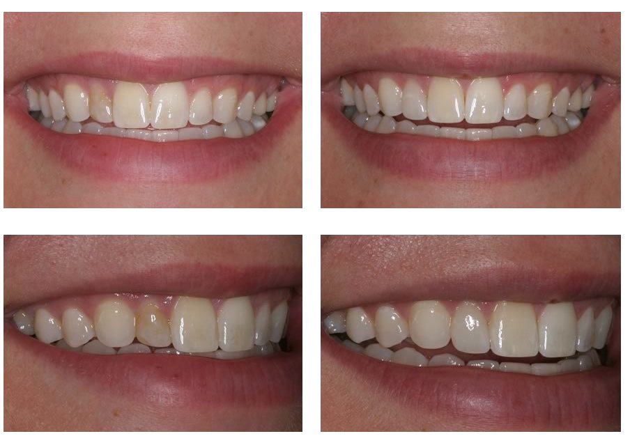 Cosmetic teeth restoration before and after smile