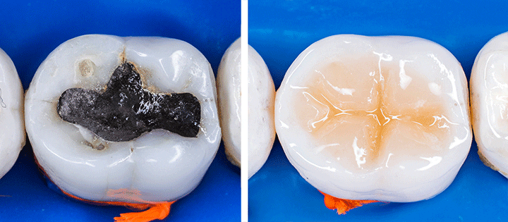 Photo of before and after composite filling