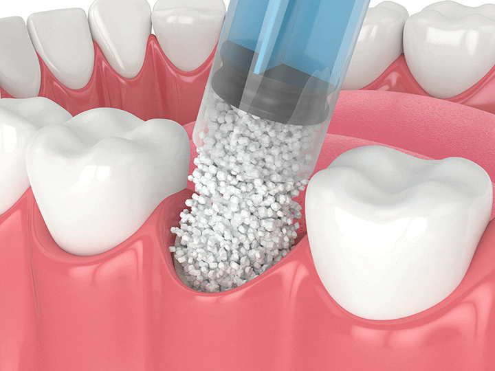 tooth extraction and bone grafting illustration