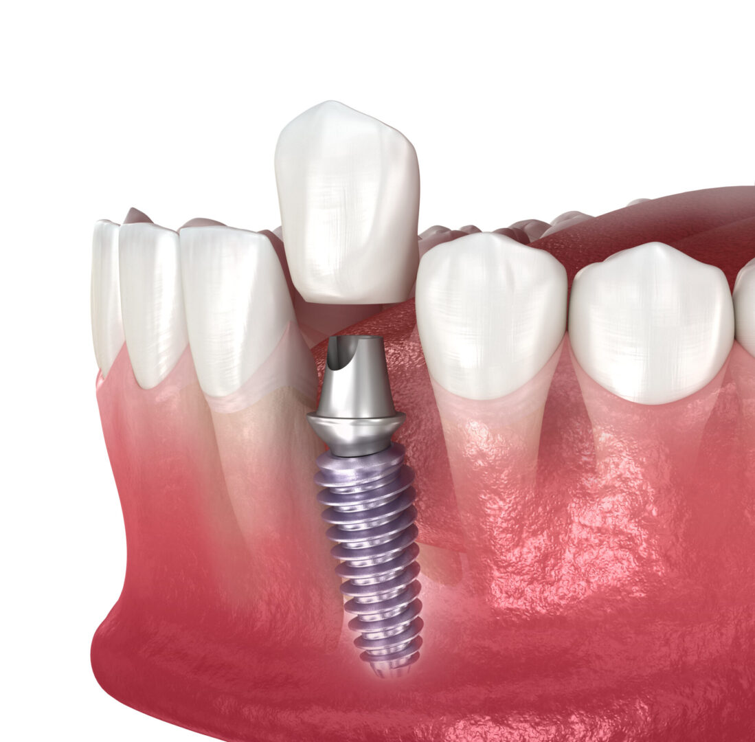 Dental implant and ceramic crown