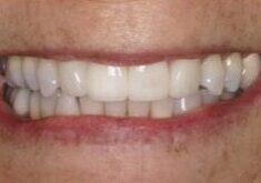 Fixed front teeth with implants