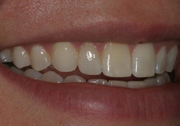 after-veneers